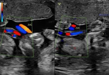 Umbilical Artery Ultrasound