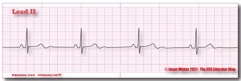 ECG Educator Blog : Sinus Bradycardia