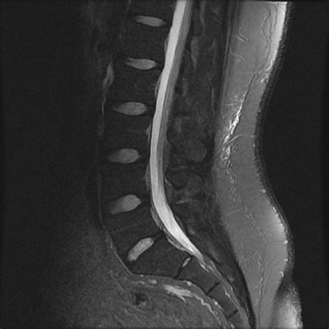 Normal Lumbar Mri Images