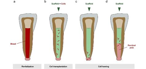 Regenerative Endodontics: Sprouting Life - Gop Convention