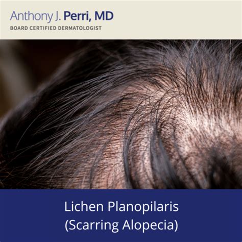 Lichen Planus - Linear Lichen Planus | Perri Dermatology