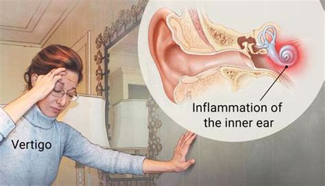 Vertigo / Inflammation of the Inner Ear | Snail in My Ear Telling Me | Know Your Meme