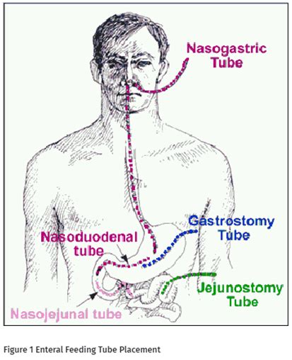 รายการ 104+ ภาพ การ ให้ อาหาร ทาง Jejunostomy สวยมาก