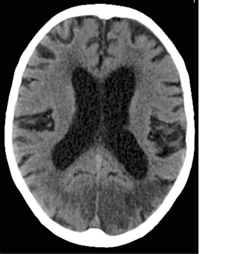 Anton's syndrome due to cerebrovascular disease: a case report ...