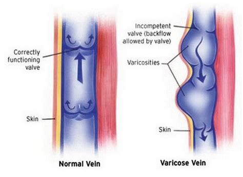 Collapsed Veins - what is a collapsed vein : Causes, Symptoms - (updated in 2022)