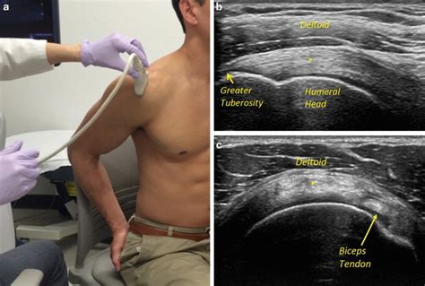 Ultrasound in Rotator Cuff Evaluation | Musculoskeletal Key