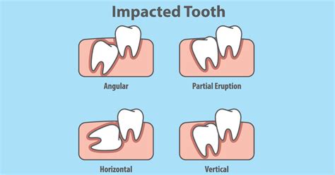 Surgical removal of impacted teeth (10)