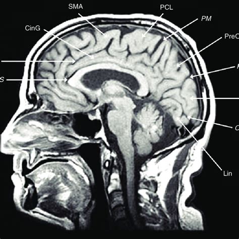 Midline sagittal T1-weighted MRI scan showing the callosal sulcus ...