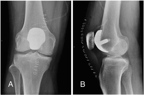 Long-Term Outcomes of Patellofemoral Arthroplasty - The Journal of Arthroplasty