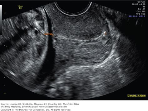 Second Trimester Obstetrical Ultrasound | Basicmedical Key