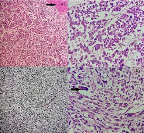 (A) Adrenocortical sarcomatoid carcinoma histological features... | Download Scientific Diagram