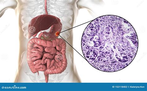 Stomach Adenocarcinoma, Gastric Cancer, Illustration and Light Micrograph Stock Illustration ...