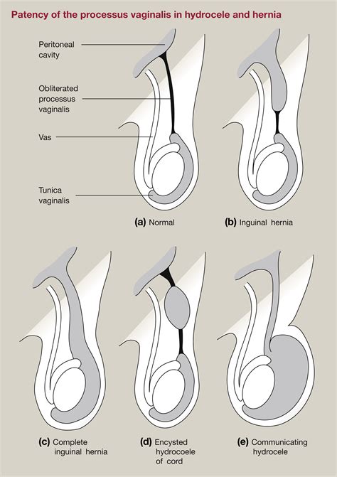 Congenital inguinal hernia, hydrocoele and undescended testis - Surgery - Oxford International ...