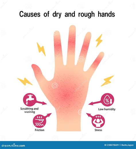 Causes of Dry and Rough Hands Chapped Hands Vector Illustration Stock Vector - Illustration of ...