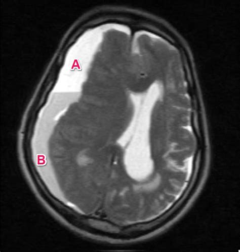 Subdural Hematoma Mri