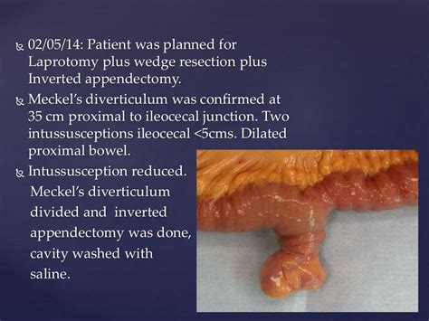 Meckels Diverticulum