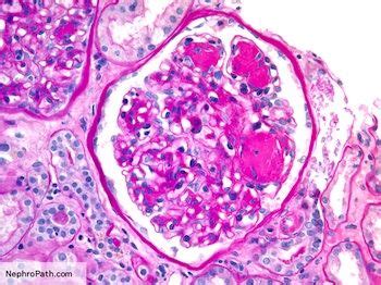 Diabetic nephropathy = Kimmelstiel-Wilson nodular sclerosis, hyaline arterioles | Diabetic ...