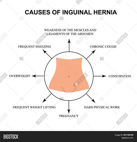 Causes Inguinal Hernia Image & Photo (Free Trial) | Bigstock