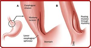 Laparoscopic Heller Myotomy for Achalasia Port Jefferson | Commack, NY