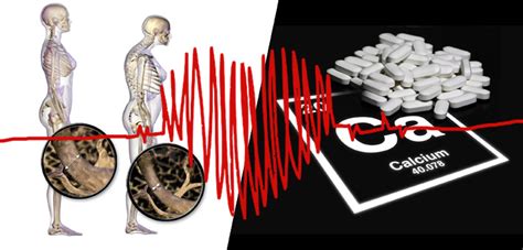 Osteoporosis, Cardiology Organizations Issue Calcium Guideline ...