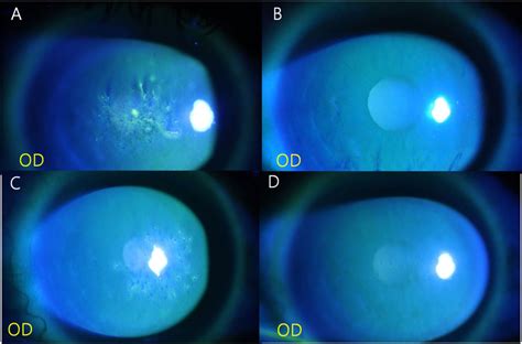 Figure 1 from Bilateral Thygeson’s Superficial Punctate Keratitis with Dendritic Corneal Lesion ...