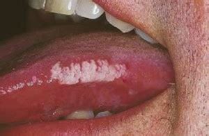 Hairy Leukoplakia - Pictures, Treatment, Diagnosis, Features