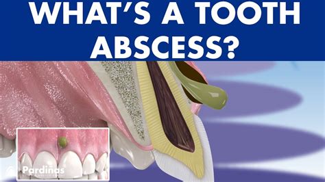 TOOTH ABSCESS dental infection - PHLEGMON symptoms and treatment © - Dental Clinic