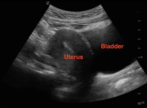 Sagittal Uterus Ultrasound