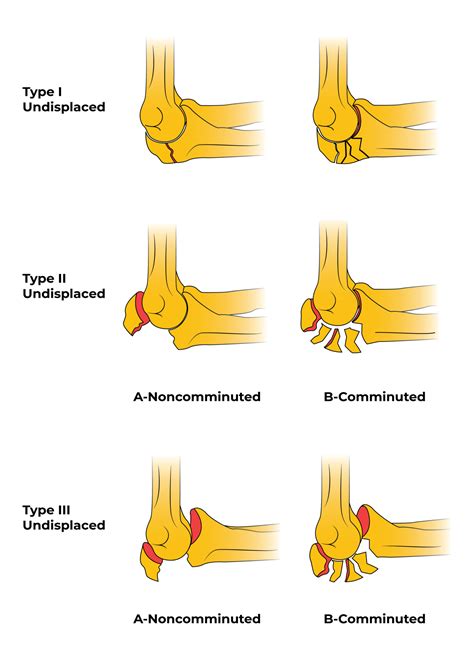 Olecranon fractures