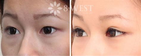 Double Eyelid Before & After Photos Patient 9