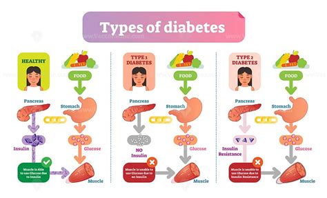 Types of Diabetes simple medical vector illustration scheme - VectorMine