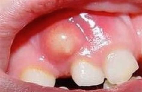 What is Oral Cyst - French Dental Services - Dr.Miski - Dubai