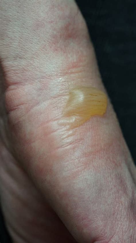 Close-up of a Woman S Hand with a Blister from a Boiled Water Burn ...