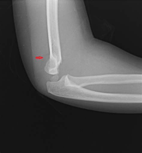 [Figure, Posterior fat pad sign (supracondylar fracture) Contributed by ...