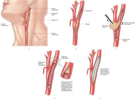 Carotid endarterectomy indications, risks, complications & recovery