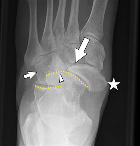 Imaging of Mueller-Weiss Syndrome: A Review of Clinical Presentations ...