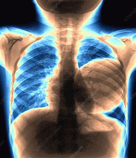 Pulmonary Cyst