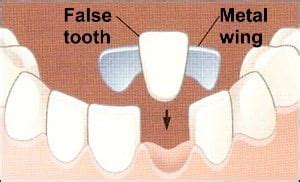 Maryland Bridge Between Two Implant Crowns - Cheek Dental