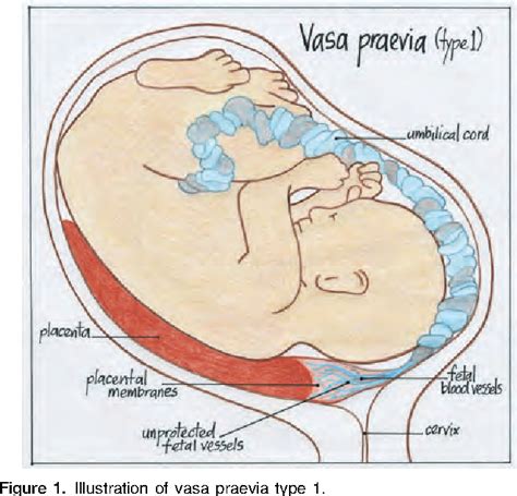 Figure 11 from Vasa Praevia; a Preventable Tragedy | Semantic Scholar