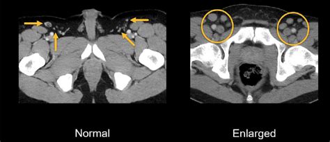 Ct Scan Enlarged Lymph Nodes