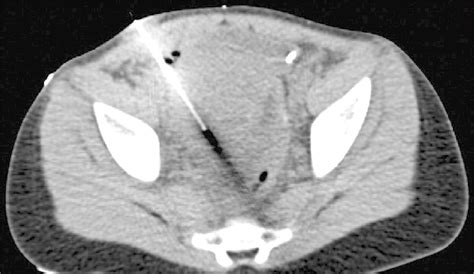 Lateral approach: A 15-year-old girl with trocar and catheter placed... | Download Scientific ...