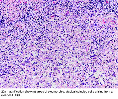 Pathology Outlines - Sarcomatoid renal cell carcinoma