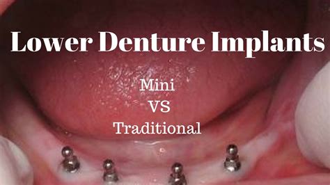 Lower Denture Implants: Mini vs Traditional - YouTube