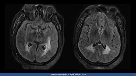 Cortical blindness | MedLink Neurology