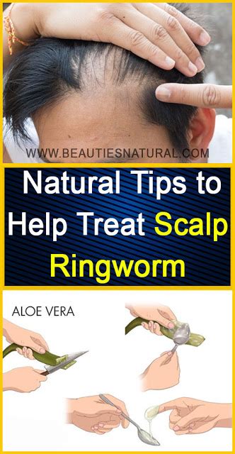 Natural Tips to Help Treat Scalp Ringworm (With images) | Ringworm, Ringworm remedies, Scalps