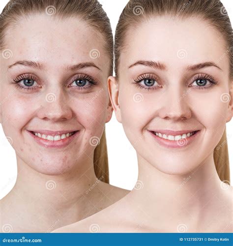 Young Woman with Acne before and after Treatment. Stock Image - Image of process, makeup: 112735731