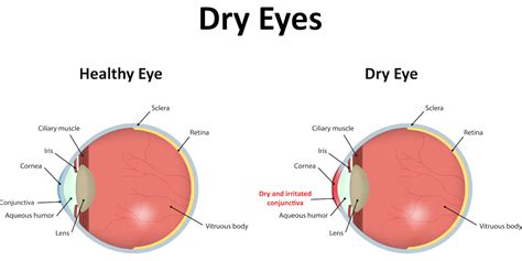 Dry Eye Syndrome - La Pine Eyecare Clinic