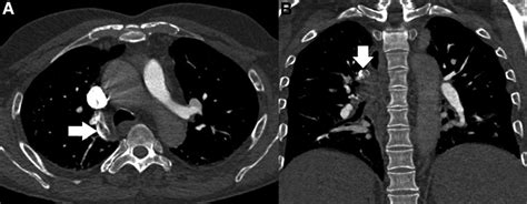 Isolated azygos vein thrombosis: a rare phenomenon | BMJ Case Reports