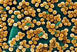 Is MRSA Contagious? | Discovery, Signs, Symptoms, & Diagnosis