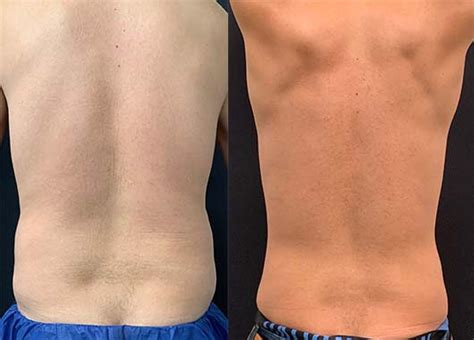 Before & After: Male Liposuction Results | Neinstein Plastic Surgery